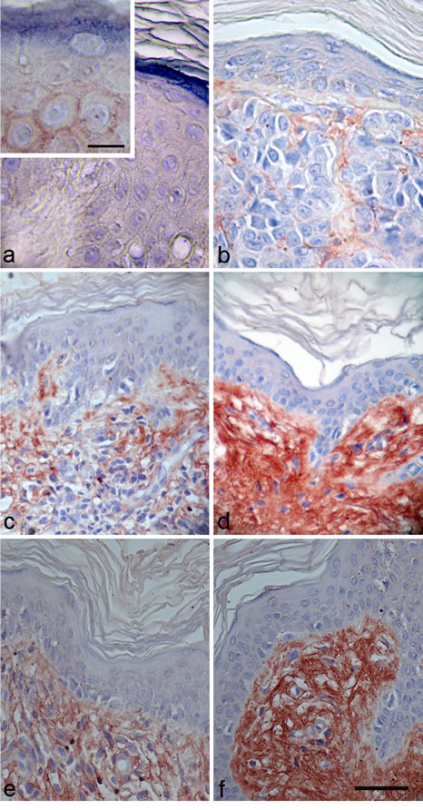 Immunostaining using a specific anti-NECL-5 antibody in a representative fraction of human melanocytic lesions of benign nevi, primary and metastatic melanoma.