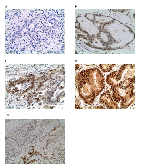Example of ER-&#x3b1; S118 staining by IHC (x400 magnification).