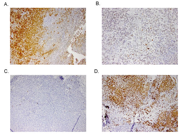 Representative IHC stains of p-ERK in A) control and B) treated PDXs (top) and caspase 3 in control and treated PDXs (bottom).