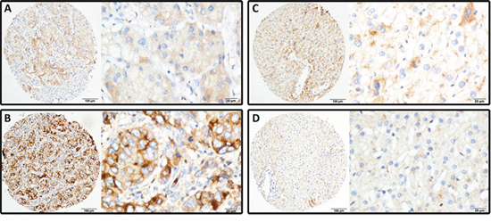 LRG1 expression is determined in HCC by immunohistochemistry.