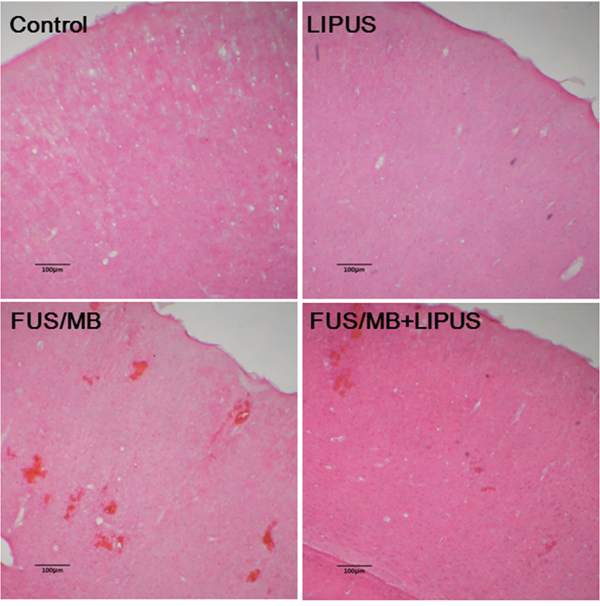 Histological evaluations with H&#x0026;E staining in the brains of a control rat and of sonicated rats with LIPUS, FUS/MB, and FUS/MB+LIPUS application.