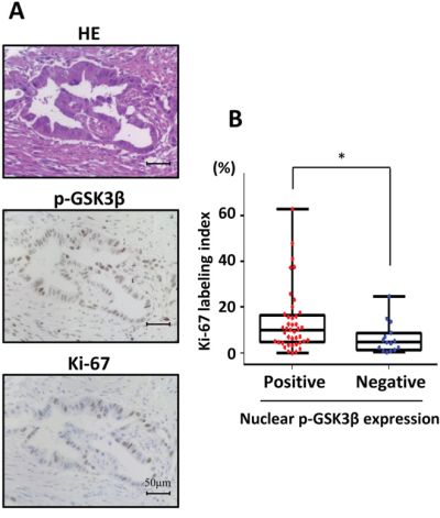 Analysis of proliferative activity using human pancreatectomy specimens according to positive or negative nuclear phosphorylated GSK3&#x03B2;Ser9 expression.