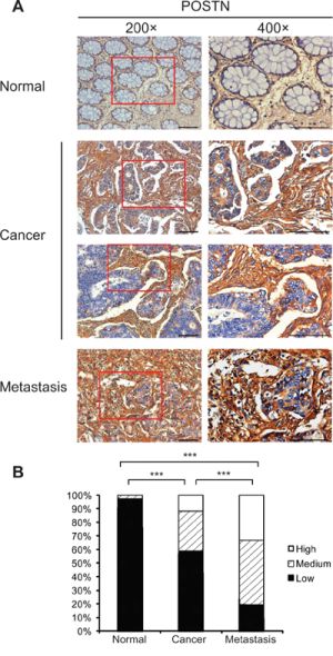 Expression pattern of POSTN in formalin-fixed paraffin-embedded specimens of adjacent pathologically normal mucosa, primary tumors, and metastatic tumors of CRC patients in Shanghai cohort.