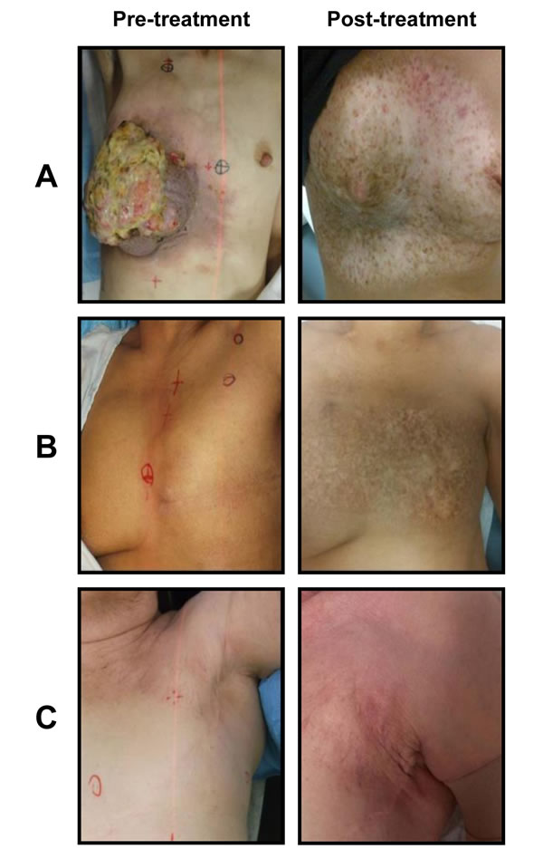 Treatment effects after whole chest wall/breast + nodal fields irradiation.