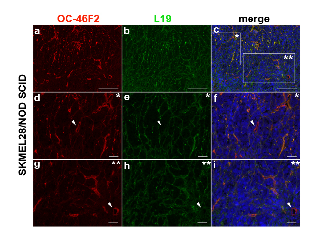 Immunofluorescence of cryostat sections of SKMEL28 melanoma tumors in NOD SCID mice double stained with OC-46F2 (a) and L19 (b) antibodies counterstained with DAPI.