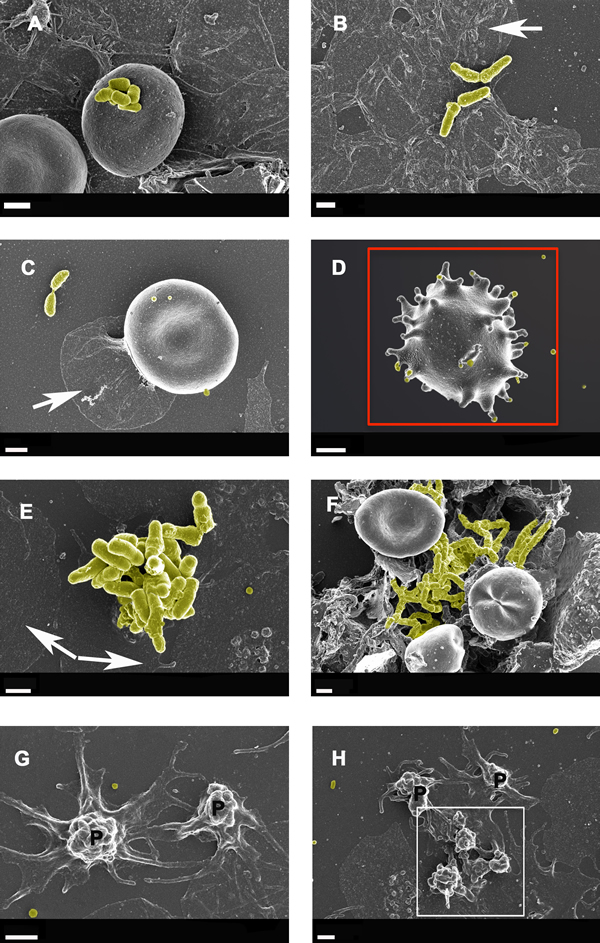 Whole blood smear showing erythrocyte and platelet interactions from Alzheimer-type dementia individuals, with bacterial presence