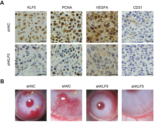 KLF5 is required for tumor angiogenesis in vivo.