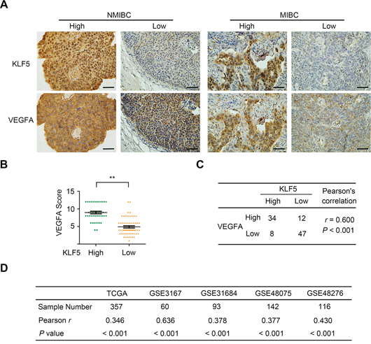 Co-expression of KLF5 and VEGFA in human bladder cancer tissues.