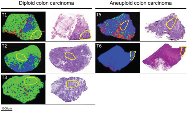 MALDI-IMS images and H&#x0026;E staining of the same section of diploid (left) and aneuploid colon carcinoma (right).