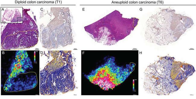 Validation of the histological distribution of T&#x03B2;-4 by immunohistochemistry in diploid (left) and aneuploid (right) colon carcinomas.