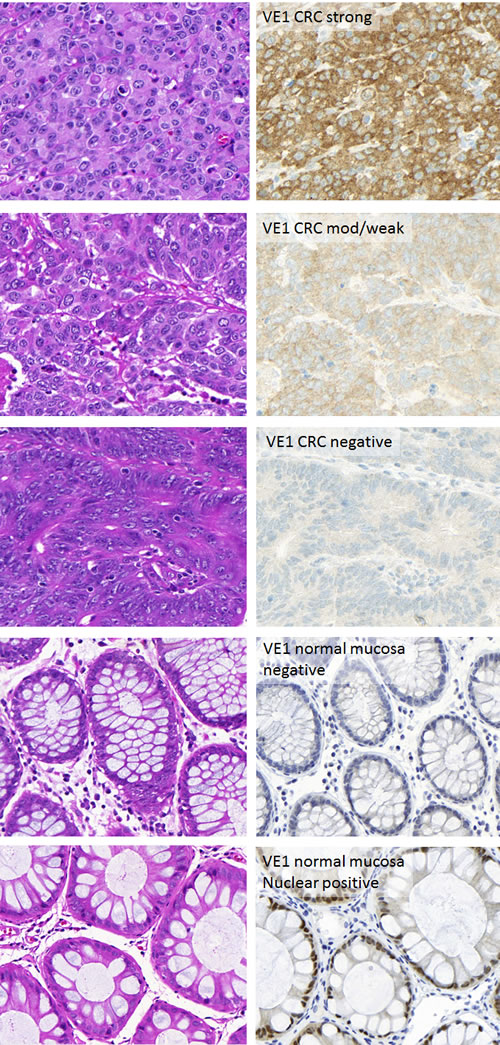 Representative images of colorectal cancers stained for VE1.
