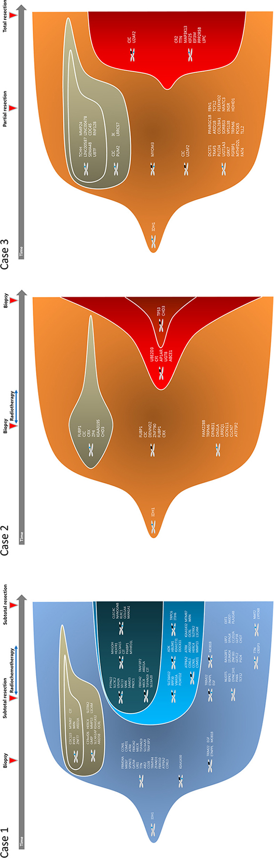 Clonal evolution from low grade to high grade gliomas.