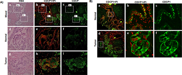Expression of CDCP1 in prostate patient tissues.