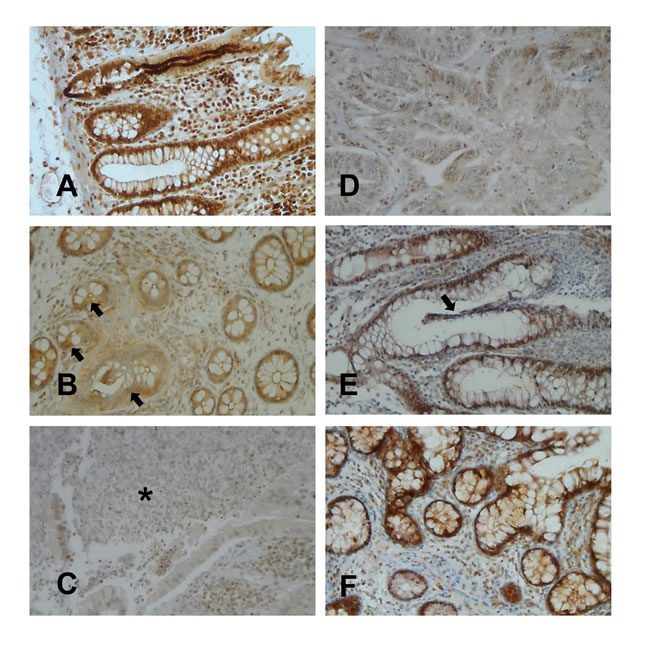 ER&#x3b2; expression in colonic mucosa from CD/UC patients.