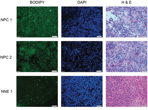Lipid droplets (LDs) are enriched in NPC tissues but not in normal nasopharyngeal tissue.