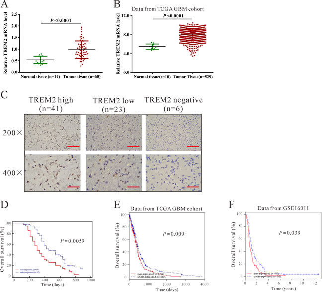 TREM2 was overexpressed in glioma tissues.