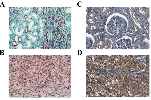 Expression of rpS6 and p-rpS6 in human RCC tissue.