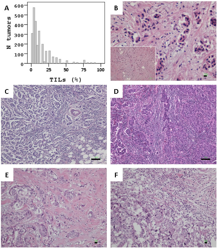 Stromal TILs in breast carcinomas.