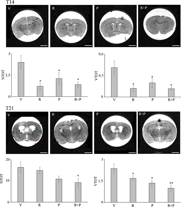 Metastasis formation in nude mice injected with MDA-MB231 cells in the two different experimental models used: the early metastatic model (T14) and a claimed brain tumor occurrence model (T21), both examined by MRI and measured by ROI segmentation.