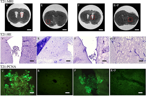 Representative MRI pictures of T21 vehicle and treated animals and HE staining and immunolocalization of PCNA in the same areas identified in the MRI images (red inset).