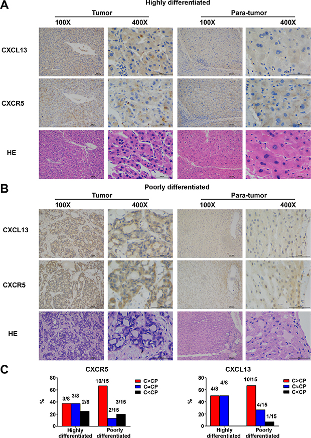 In situ expression of CXCL13 and CXCR5 in 23 paired HCC tumor and para-tumor tissues.