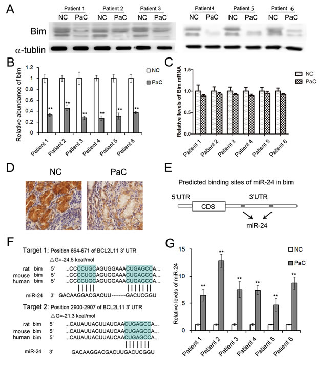 The expression patterns of Bim and miR-24 in PaC tissues.