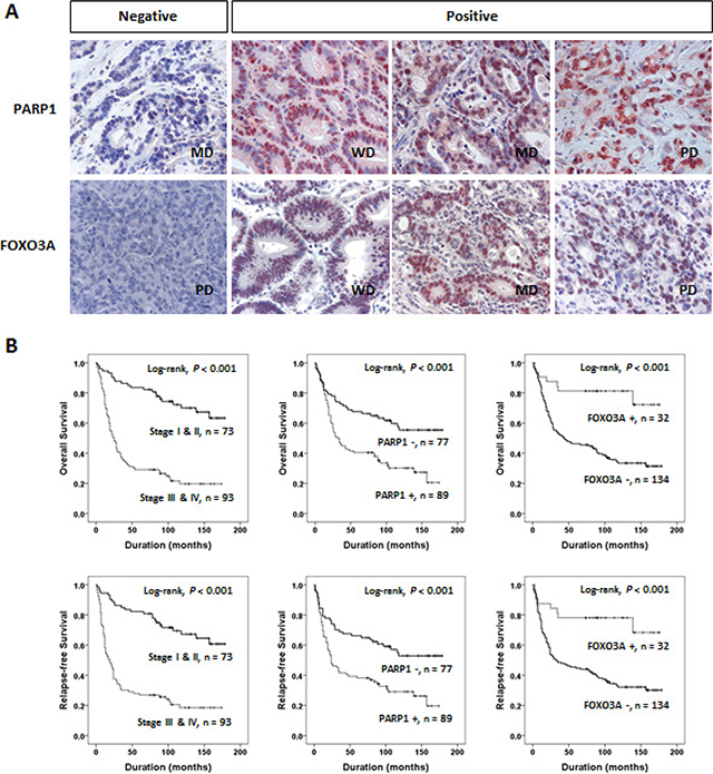 PARP1 and FOXO3A expression are associated with clinical outcomes of gastric cancer.