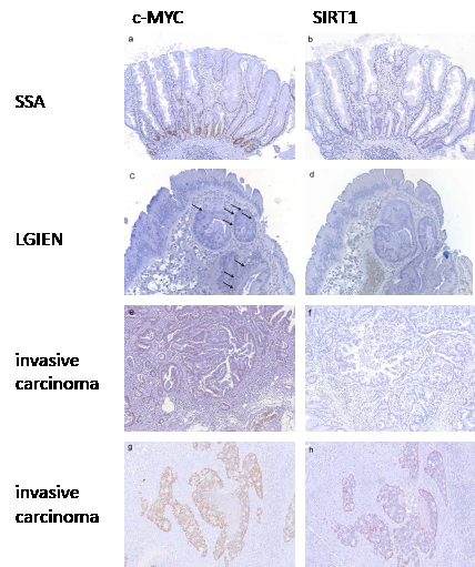 c-MYC and SIRT1 expression in serrated lesions with wild type