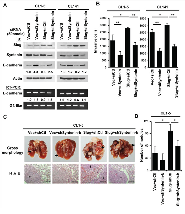 Knockdown of MDA-9/Syntenin expression decreased Slug-promoted E-cadherin suppression and cancer invasion/metastasis.