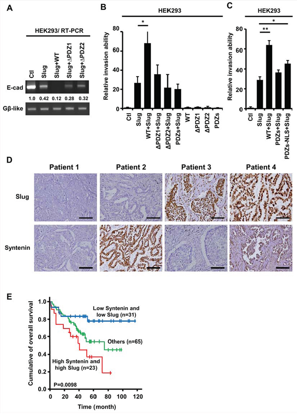 The PDZ domains of nuclear MDA-9/Syntenin were required to enhance Slug-regulated cell invasion and the expressions of Slug/Syntenin were associated with poor survival in patients with lung adenocarcinoma.
