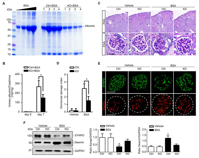 Podocyte specific knockout of GSK3&#x3b2; attenuates proteinuria and ameliorates oxidative glomerular injury in protein overloaded mice.