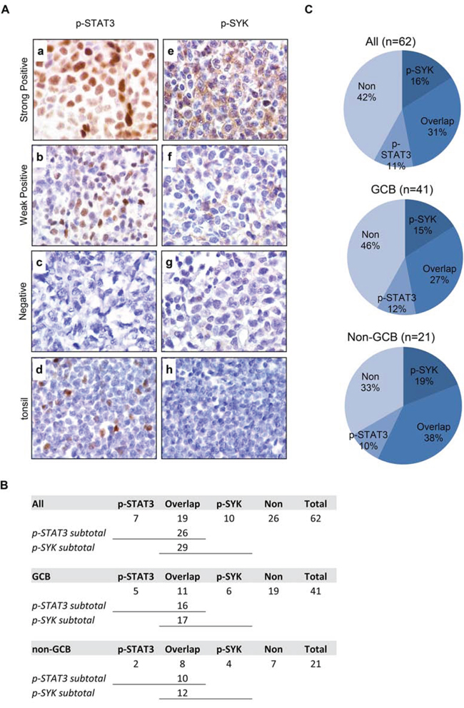 Expression of p-STAT3 (Y705) and p-SYK (Y525/526) in normal tonsil and primary DLBCL tissues on tissue microarray.