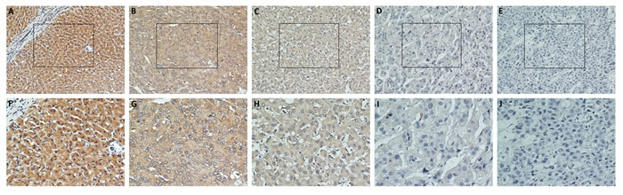 Immunohistochemical analysis of TPD52 protein expression in primary HCC surgical specimens.