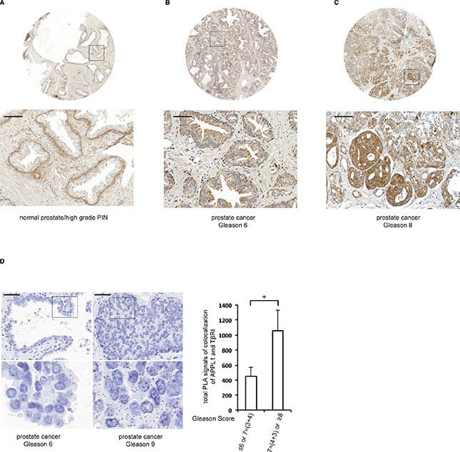 The expression of APPL1 differs in normal versus malignant prostate tissue.