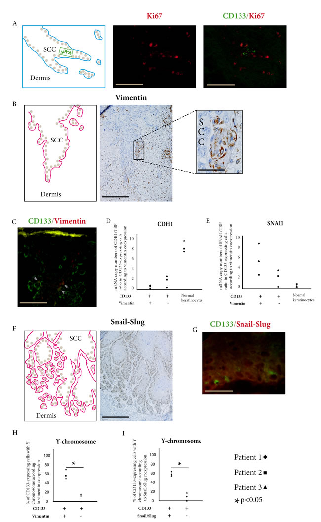 Donor-derived stem cells express EMT markers in squamous cell carcinoma.