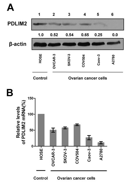 Repression of PDLIM2 expression in ovarian cancer cell lines.