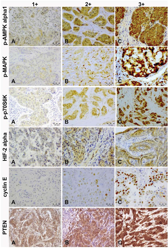 Immunohistochemical intensity scoring of p-AMPK alpha1, p-MAPK, p-p70S6K, HIF-2 alpha, cyclin E and PTEN (magnification, x20).