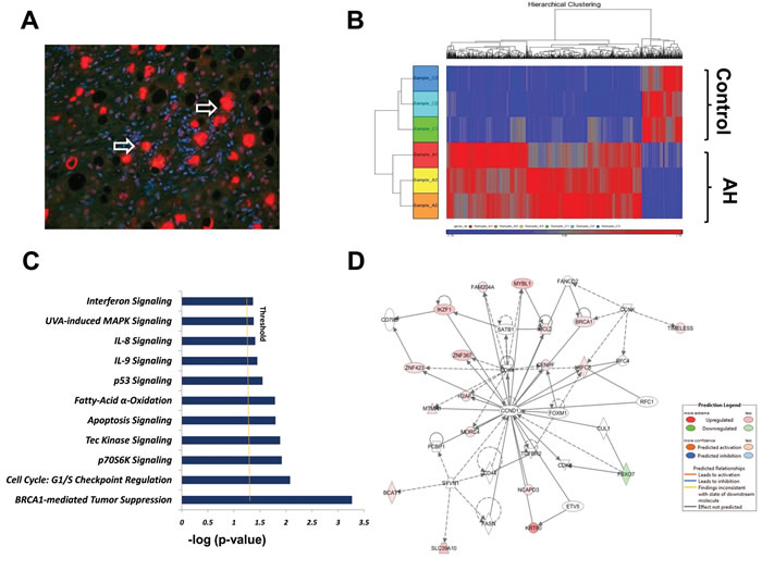 High-resolution transcriptsome analysis of human AH livers with MDBs present.