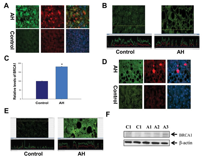 Altered modulation of the BRCA1-mediated pathway in the liver of AH livers with MDBs.