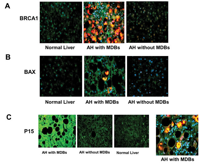 The liver sections from AH patients with MDBs, AH patients without MDBs and controls were double stained with antibodies to BRCA1