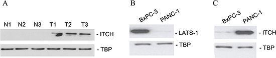 ITCH protein expression correlate with metastatic potential in patient samples and in cell lines.