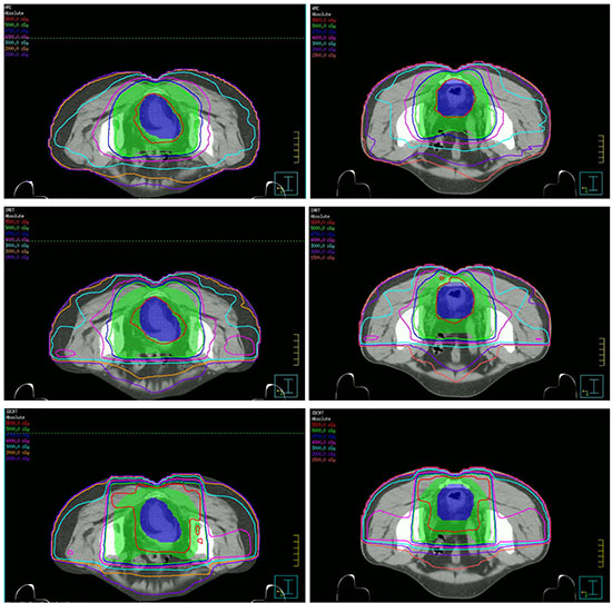 Dose distributions of three planning techniques for two patients in the axial slices.