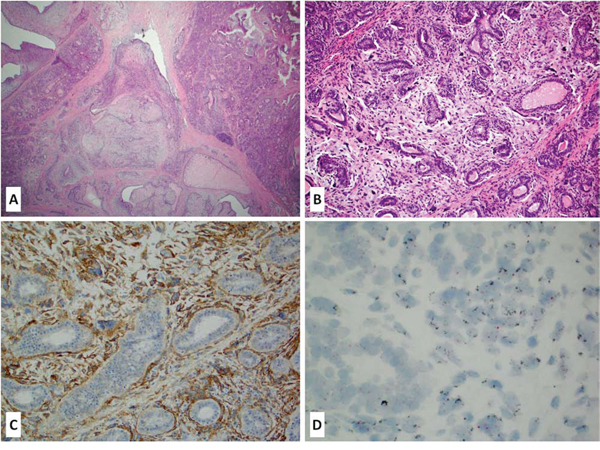Figure 1A-D: Primary malignant phyllodes tumor of the breast (A-B H&E stain, 10&ndash;20x magnification) with a strong membranous EGFR protein overexpression (C &ndash; IHC stain) accompanied by EGFR gene amplification (D &ndash; CISH).
