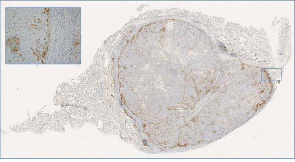 A case of metastatic phyllodes tumor to the lung with peripheral PD-L1 expression adjacent to the inflammatory cells and normal lung parenchyma; of note this case harbored RB1 gene mutation in both primary and metastatic tumor.