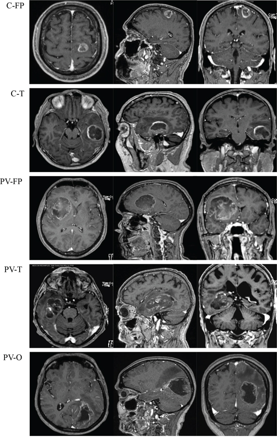 Magnetic resonance imaging with T1 enhancement (axial (left), sagittal (middle) and coronal (right)) of five tumor locations.