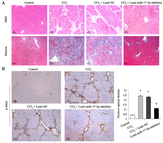 MiR-17-5p inhibitor treatment significantly suppressed rat liver fibrosis caused by CCl