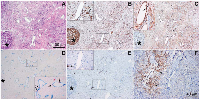 Hypoxia-related protein expression in an extrahepatic perihilar cholangiocarcinoma (Klatskin tumor) resection specimen.
