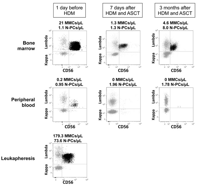 Assessment of Multiple Myeloma Cells and Normal Plasma cells in representative patients with Multiple Myeloma before and after high dose melphalan.