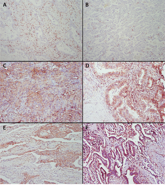 Staining of tumor infiltrating CD8+ T cells, &#x03B2;2-microglobulin, HLA-A, HLA-B/C and HLA-E in pulmonary adenocarcinoma.