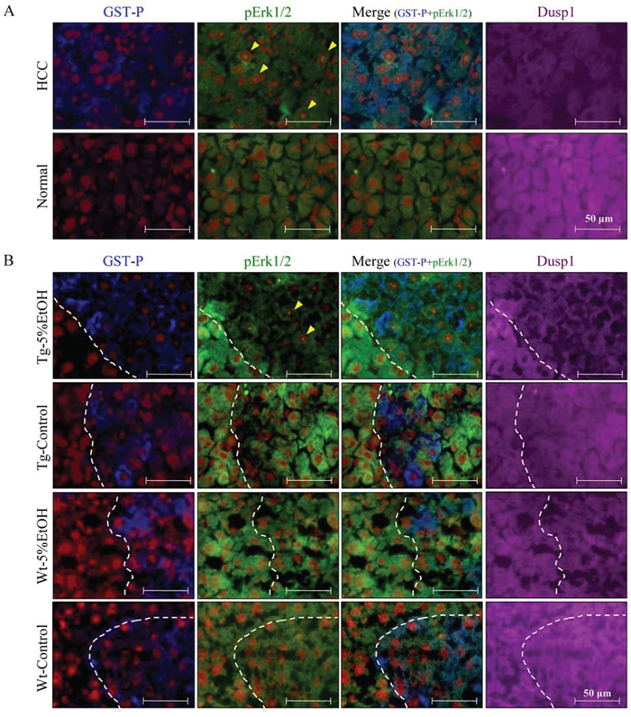 Figure 5. Localization of GST-P (blue), pErk (green), Dusp1 (purple), and nuclei (red) by triple immunofluorescence staining in HCC and normal tissue of the Tg-5%EtOH group